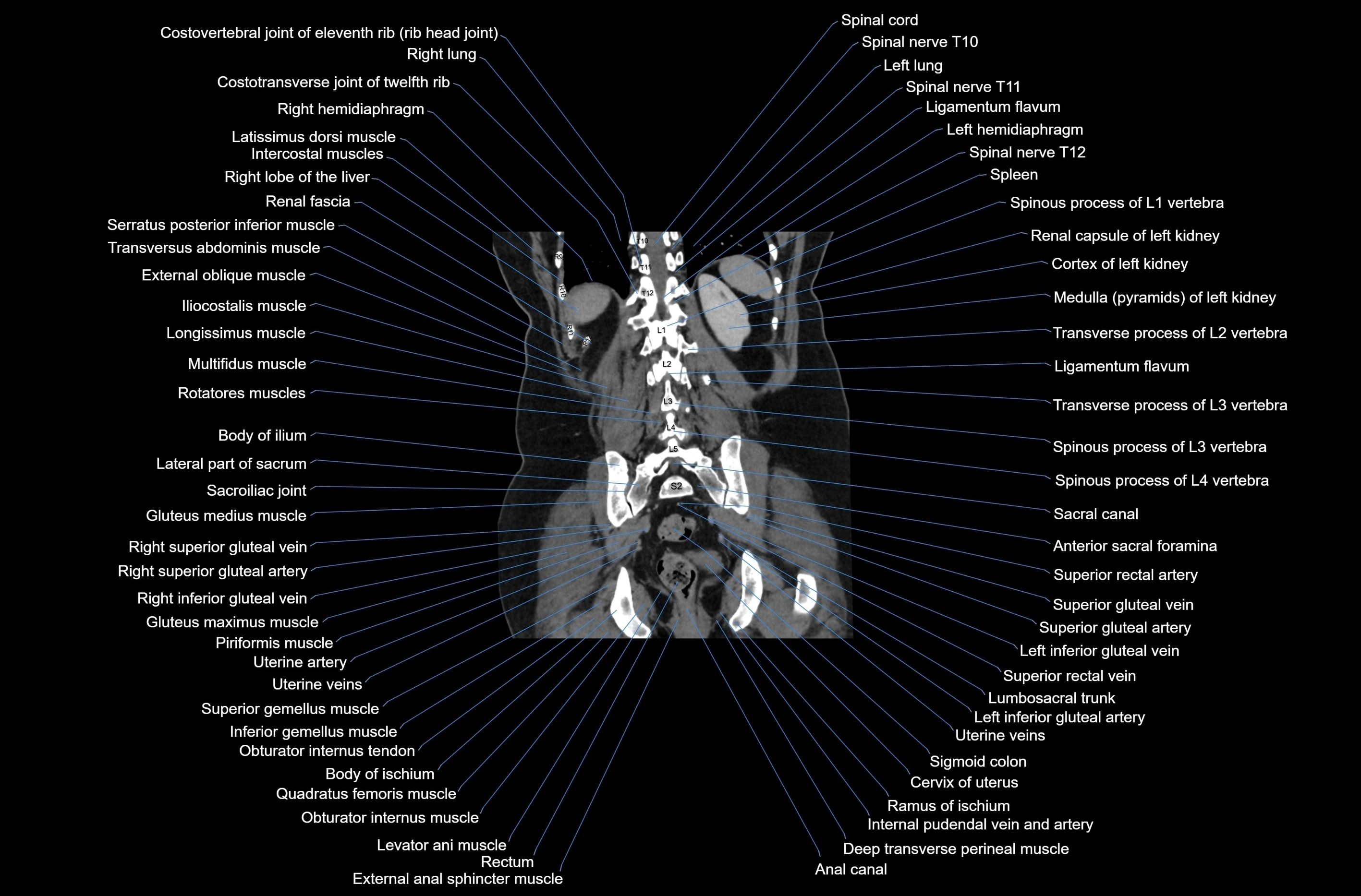 CT abdomen coronal cross sectional anatomy labelled radiology image-00066.webp